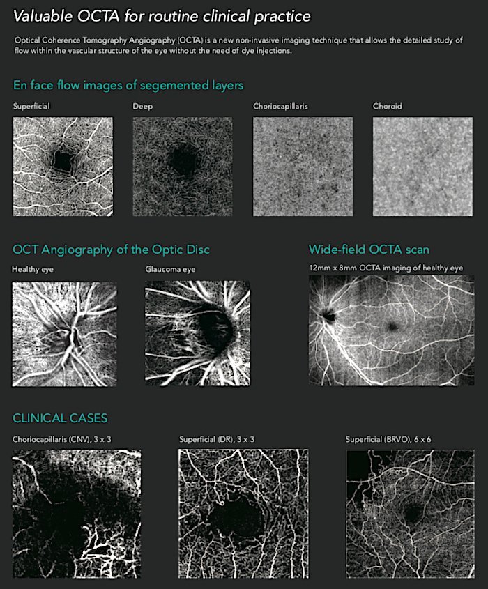 Tomografia coerenza ottica_Mocean_4000_8_Dr. Alberto Bellone