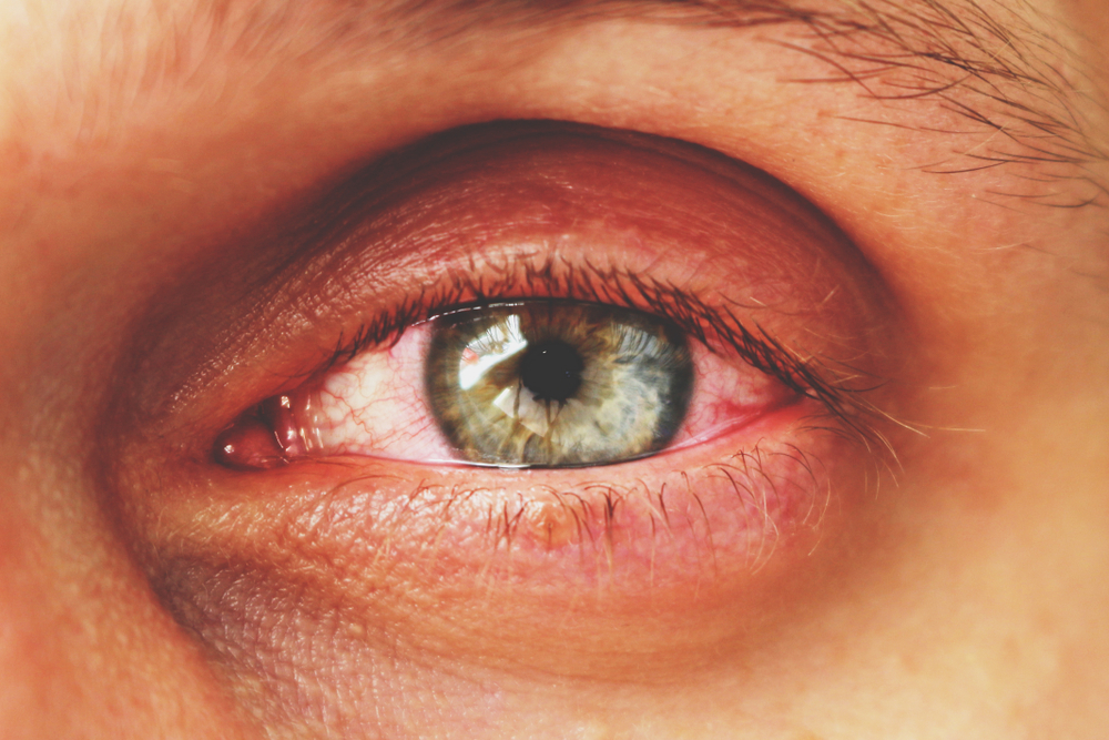 Conjunctivitis