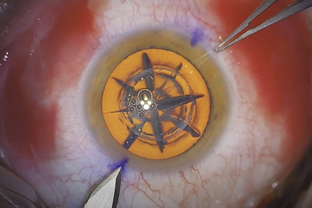 Impianto di TECNIS PureSee™ IOL con Tecnologia Femtolaser