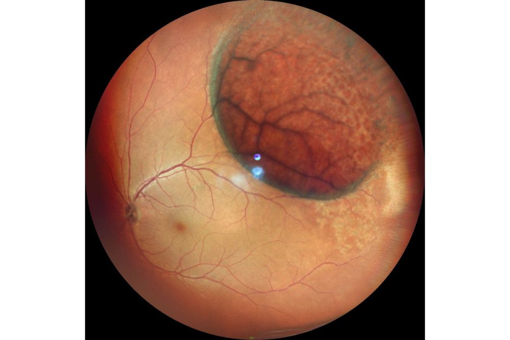 Retinoschisi