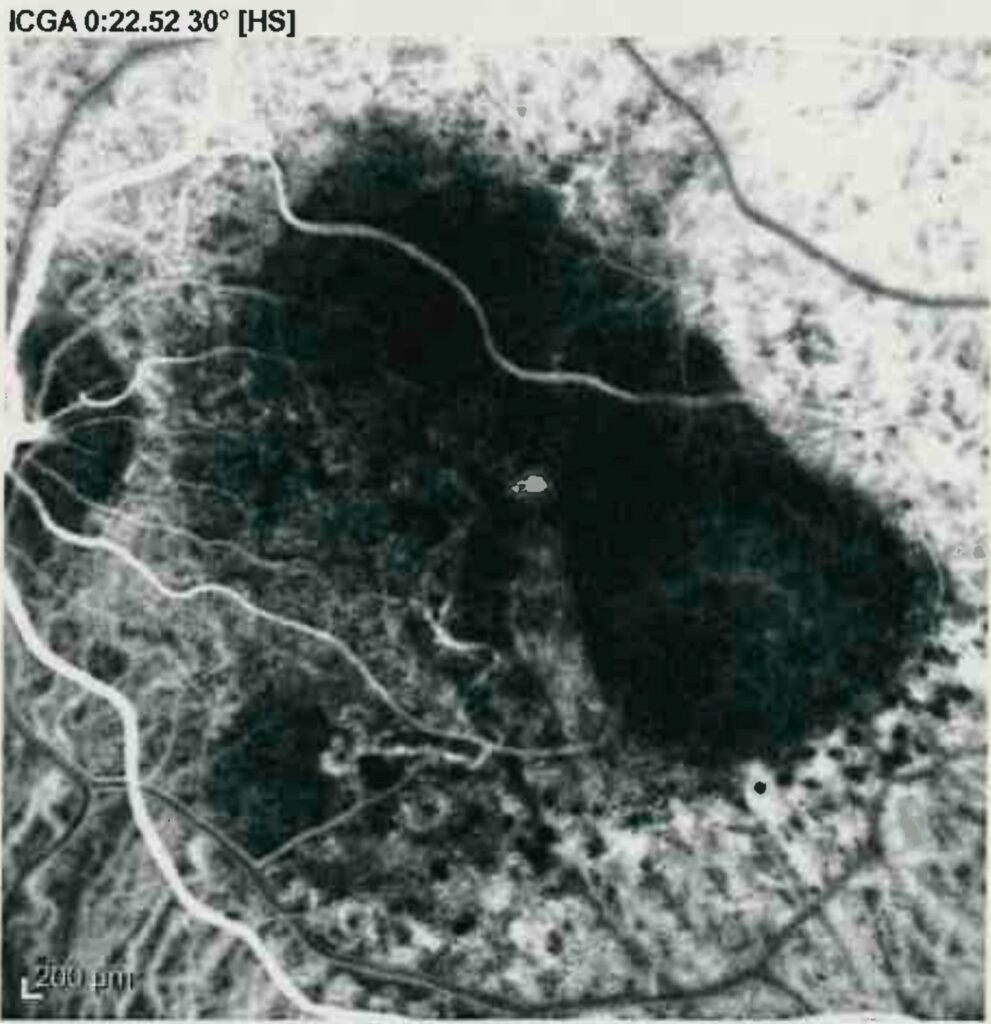 fluoroangiografia verde indocianina