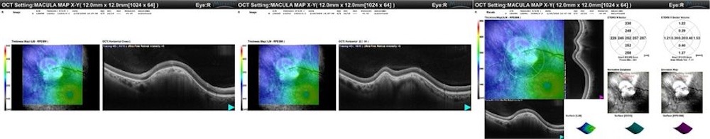 oct calcificazioni sclerocoroideali