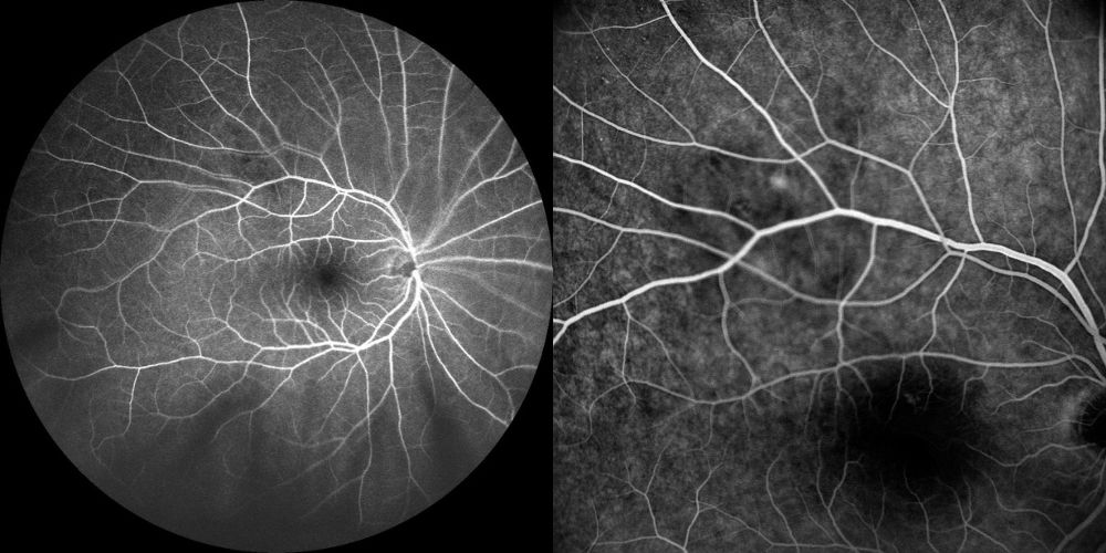 fluorangiografia calcificazioni sclerocoroideali 1