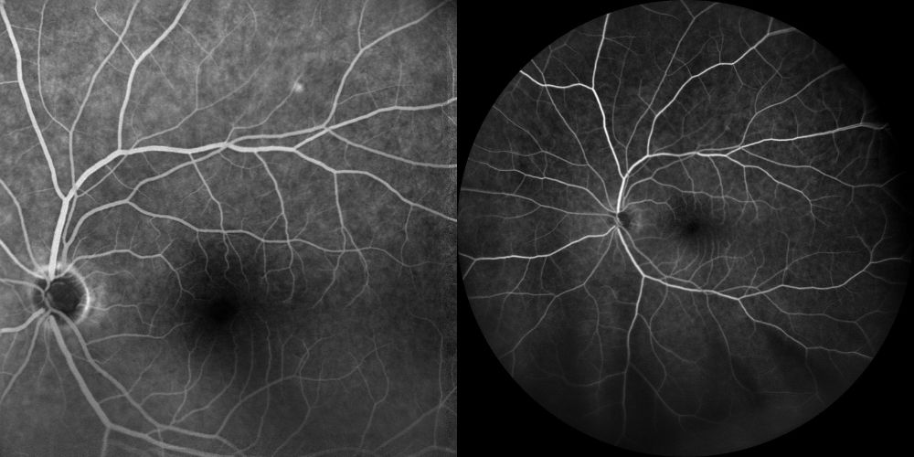 fluorangiografia calcificazioni sclerocoroideali 2