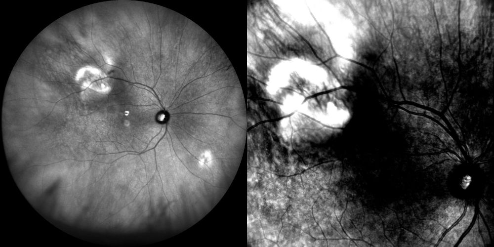 infrarosso calcificazioni sclerocoroideali 1