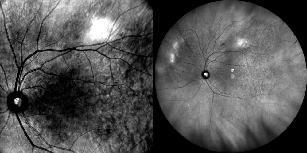 infrarosso calcificazioni sclerocoroideali 2