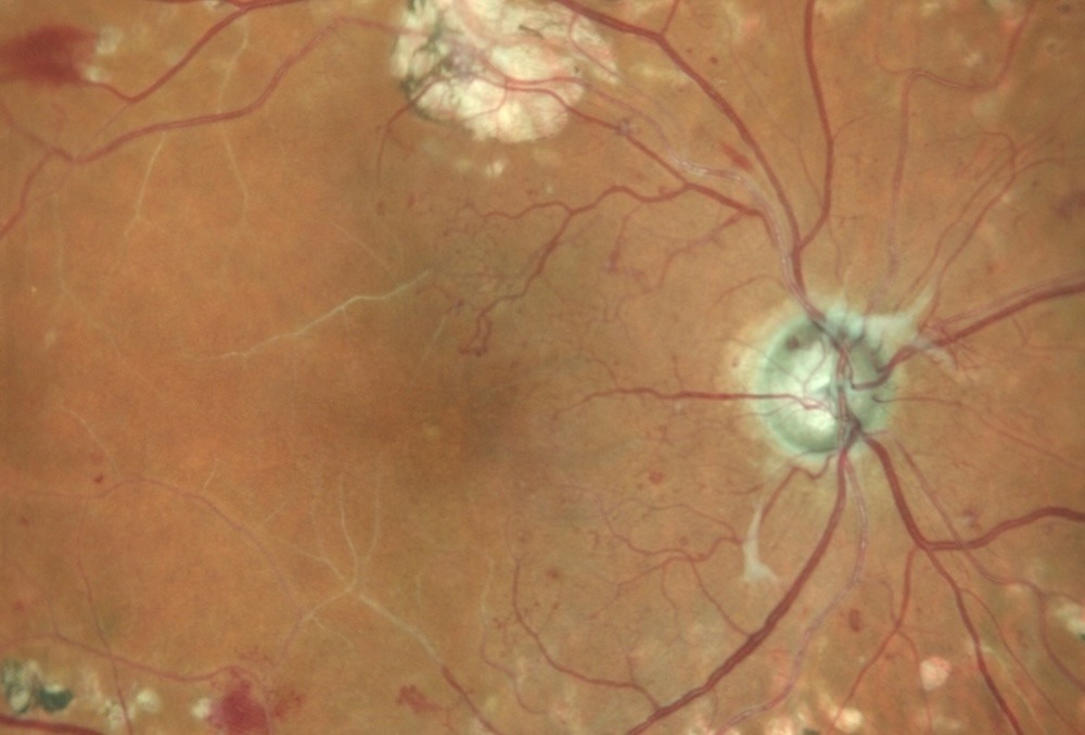 Fundus oculi con essudati cotonosi, segno tipico del peggioramento precoce della retinopatia diabetica