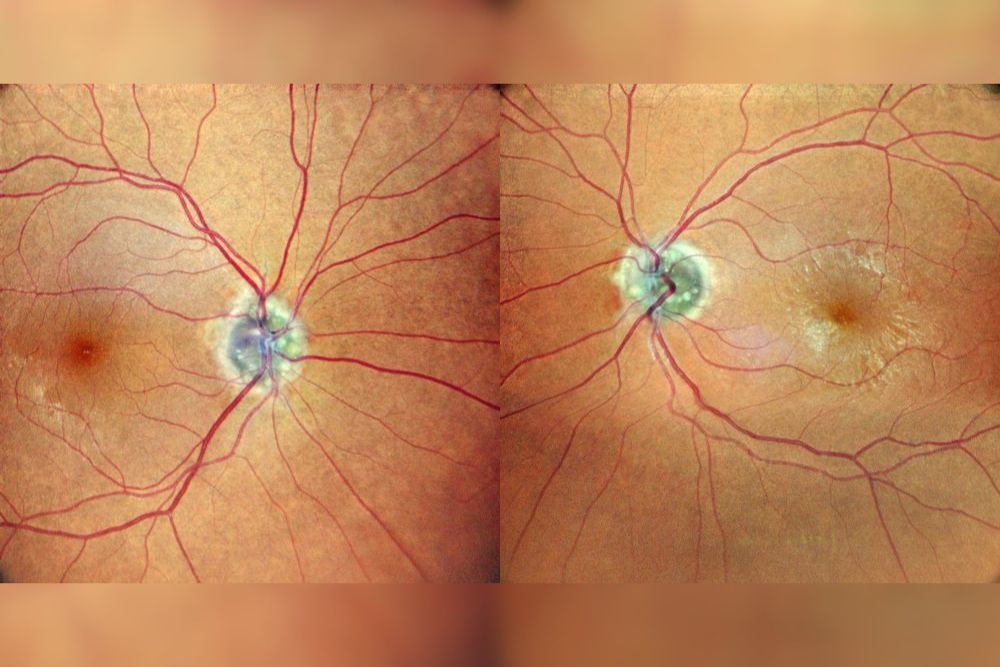 Drusen del nervo ottico