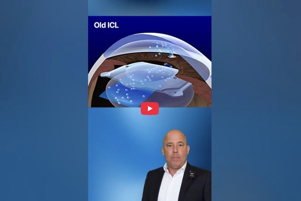 Occhio bionico la vera storia delle lenti ICL Visian