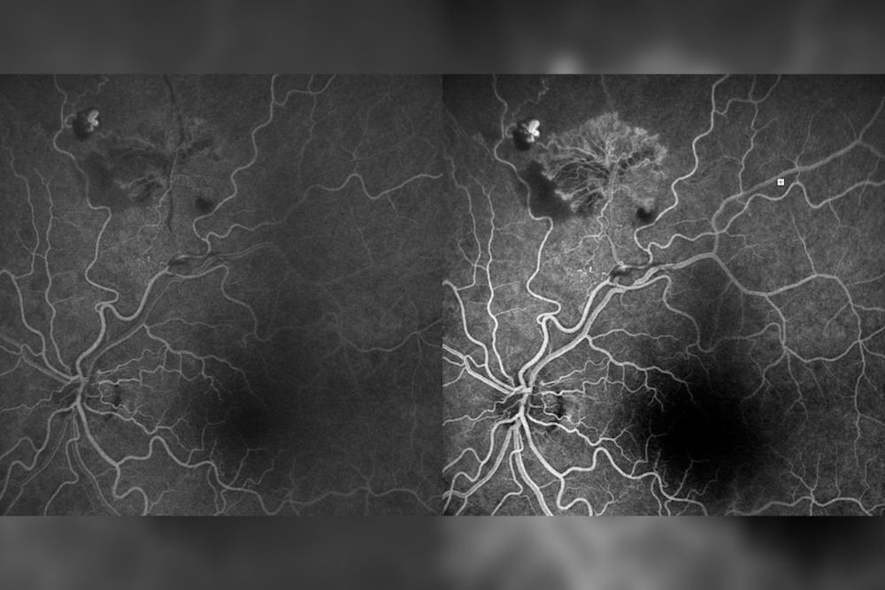 Retinopatia ischemica proliferante