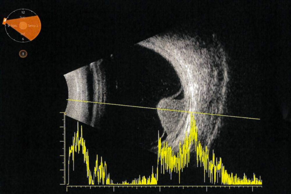 Trattamento del melanoma uveale maligno