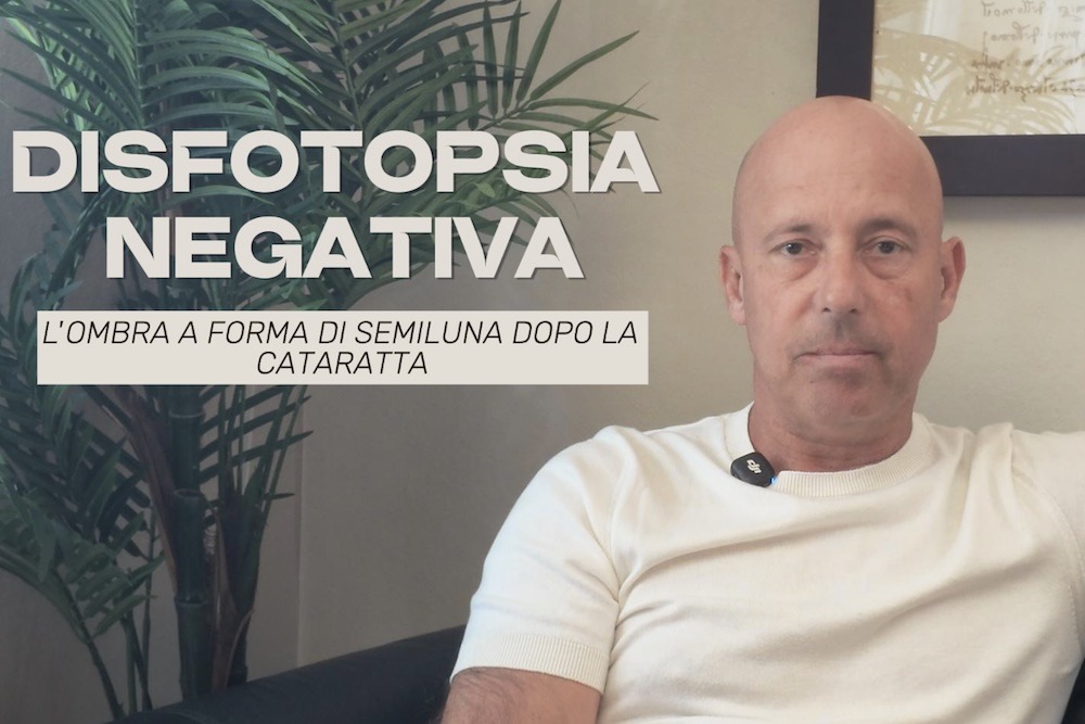 Il Dott. Alberto Bellone spiega la disfotopsia negativa, l’ombra a forma di semiluna dopo la cataratta