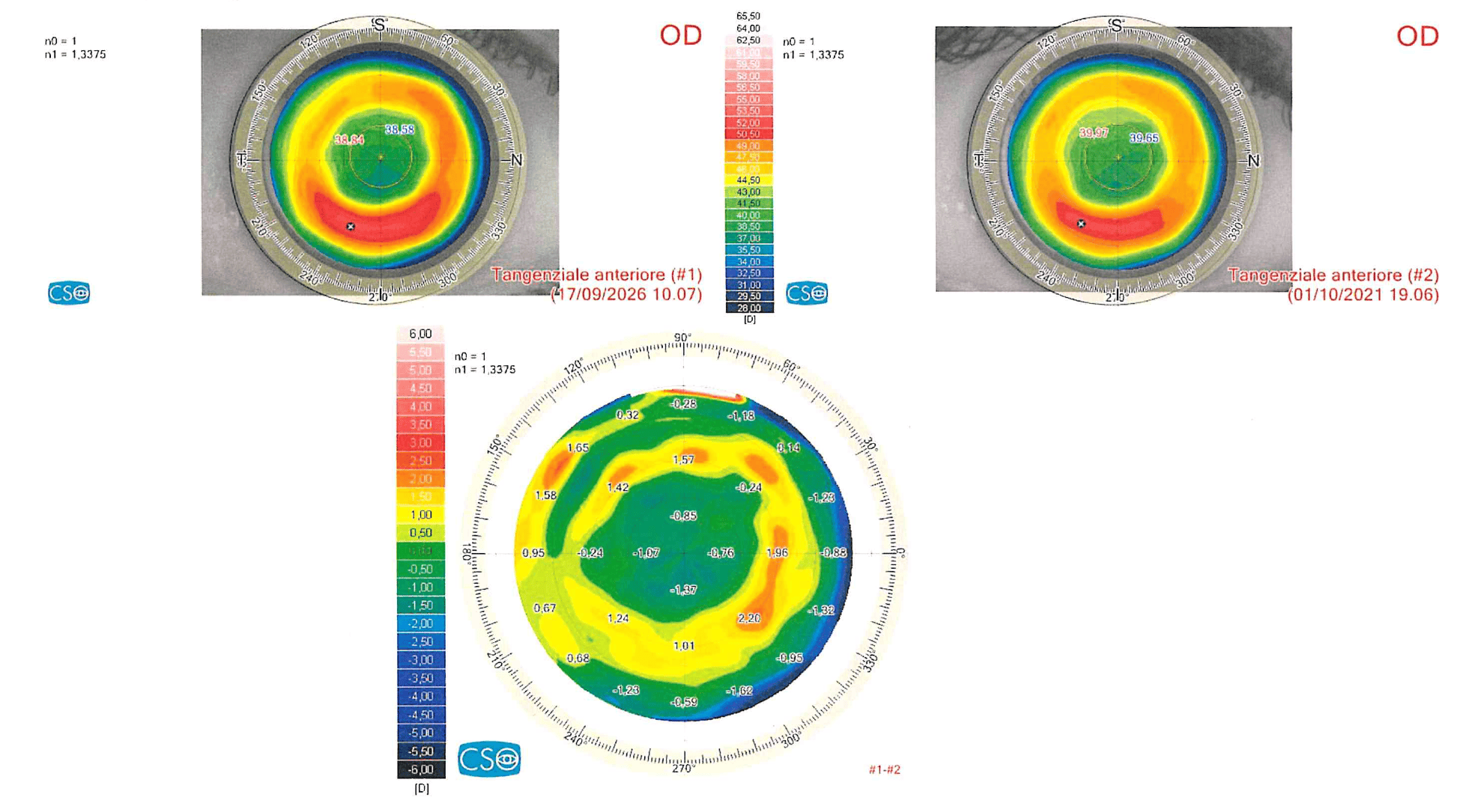 Topografia corneale occhio destro dopo cheratotomia radiale: mappe tangenziali 2021 e 2026 e mappa differenziale