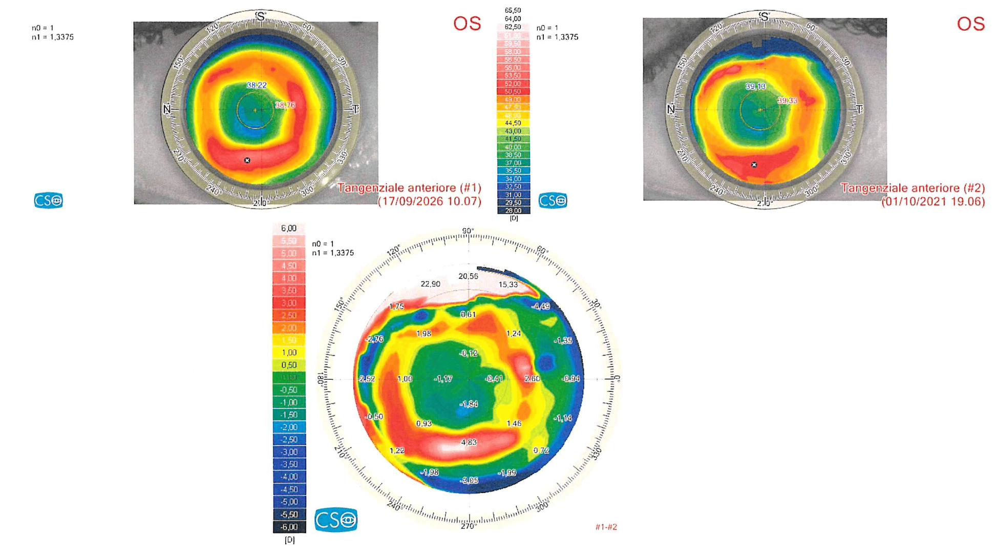 Topografia corneale occhio sinistro dopo cheratotomia radiale: mappe tangenziali 2021 e 2026 e mappa differenziale