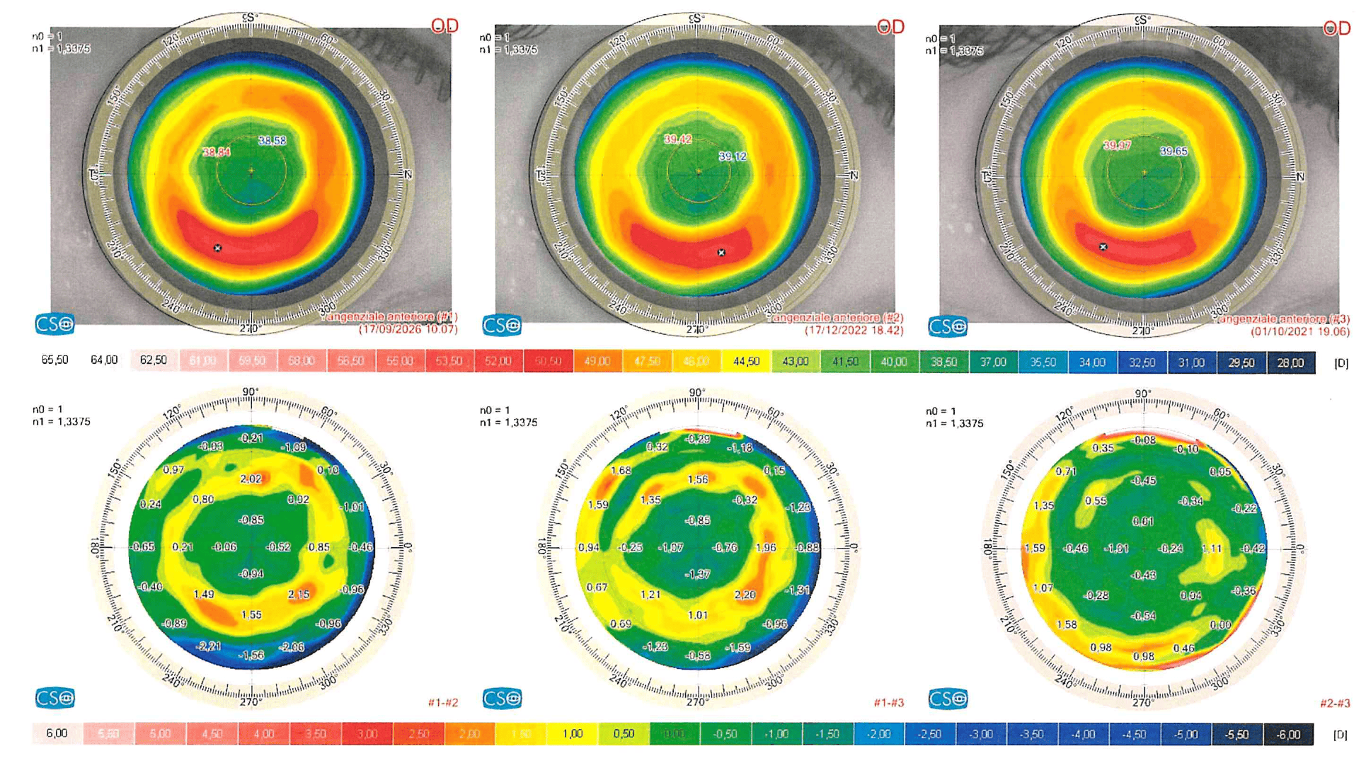 Occhio destro dopo cheratotomia radiale: mappe tangenziali 2021, 2022, 2026 e mappe differenziali