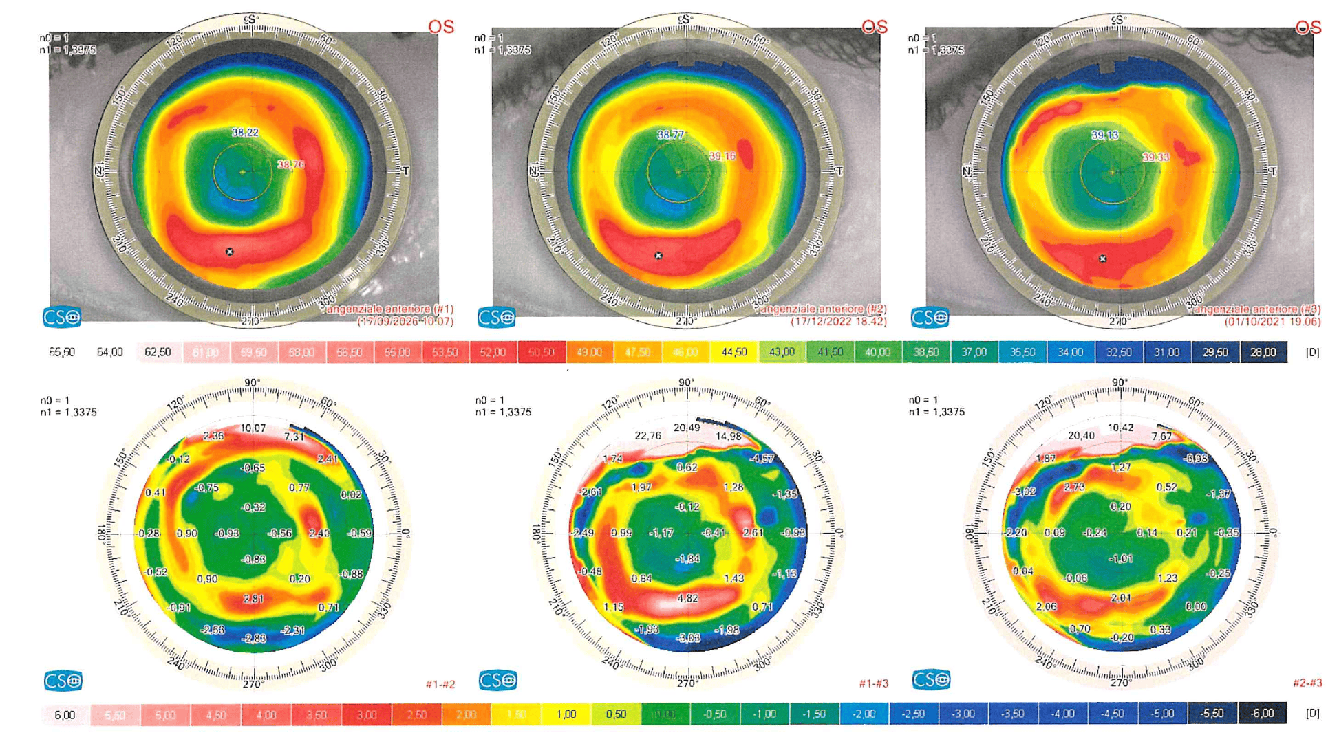 Occhio sinistro dopo cheratotomia radiale: mappe tangenziali 2021, 2022, 2026 e mappe differenziali