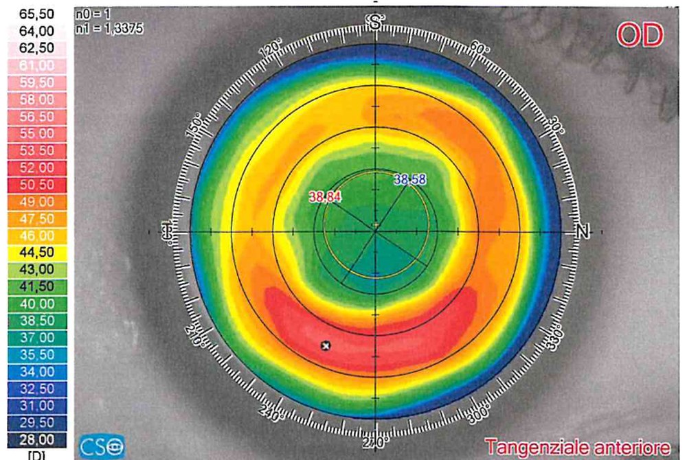 Sirius corneal topography, anterior tangential map of the right eye after radial keratotomy: flat centre and steeper peripheral ring