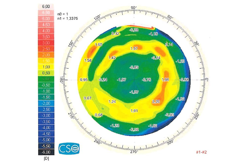 Mappa differenziale della topografia corneale (Sirius) dell'occhio destro dopo cheratotomia radiale, 2026 meno 2021: appiattimento della zona centrale