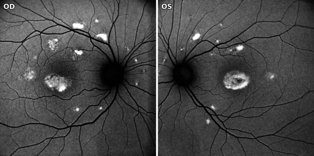 Autofluorescenza del fundus: flecks iperautofluorescenti in entrambi gli occhi, placca foveale in OD e anello con centro atrofico in OS