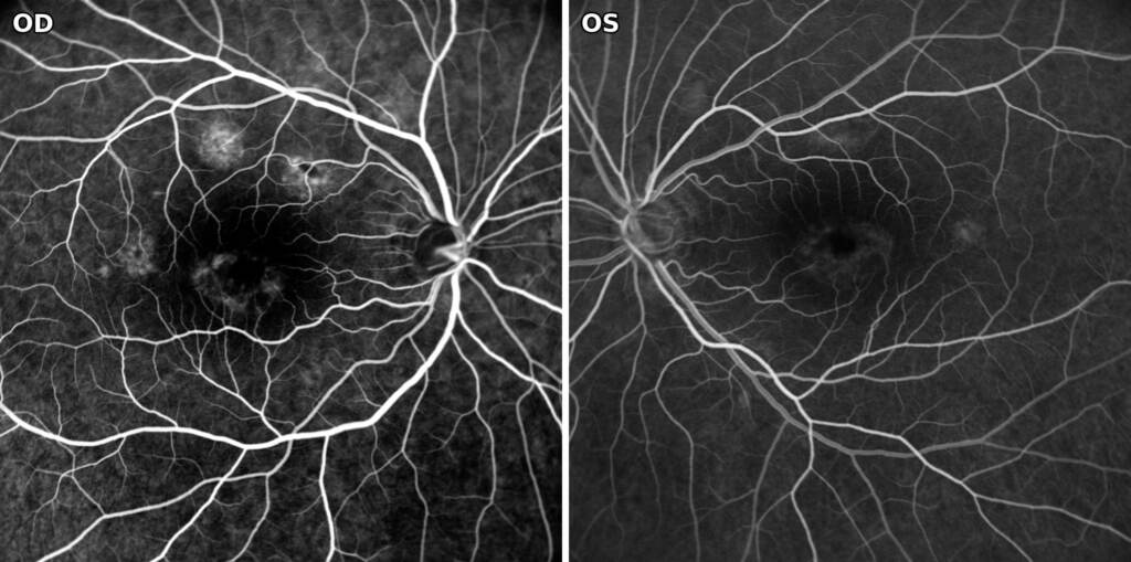 Fluorangiografia in fase precoce di entrambi gli occhi: sfondo coroideale scuro (dark choroid) e flecks iperfluorescenti