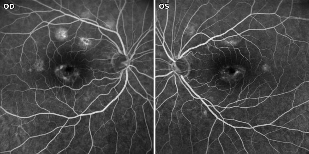 Fluorangiografia in fase tardiva: impregnazione dei flecks e lesione foveale con iperfluorescenza a corona, senza leakage