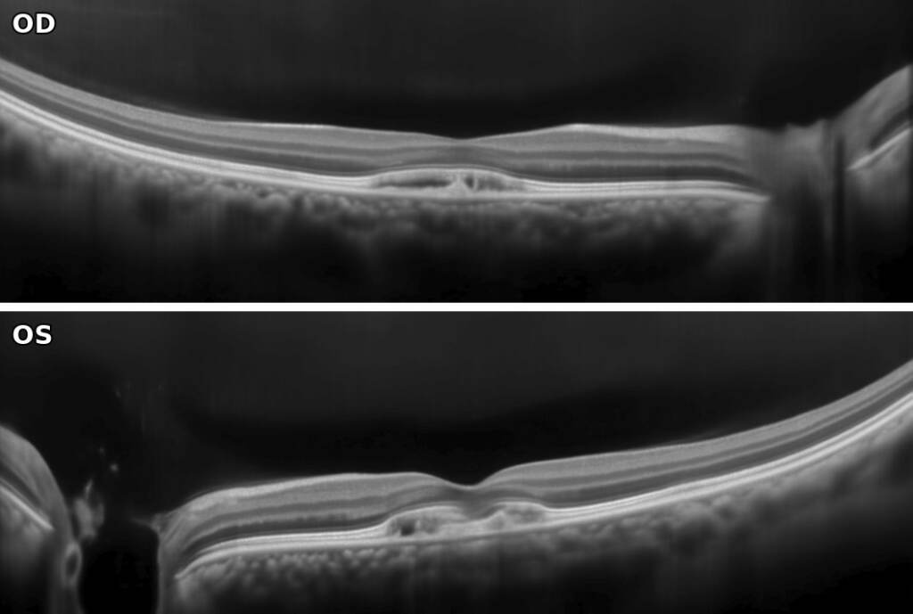 OCT maculare, scansione orizzontale di entrambi gli occhi: deposito sottofoveale a cupola in OD, deposito irregolare con retina esterna interrotta in OS